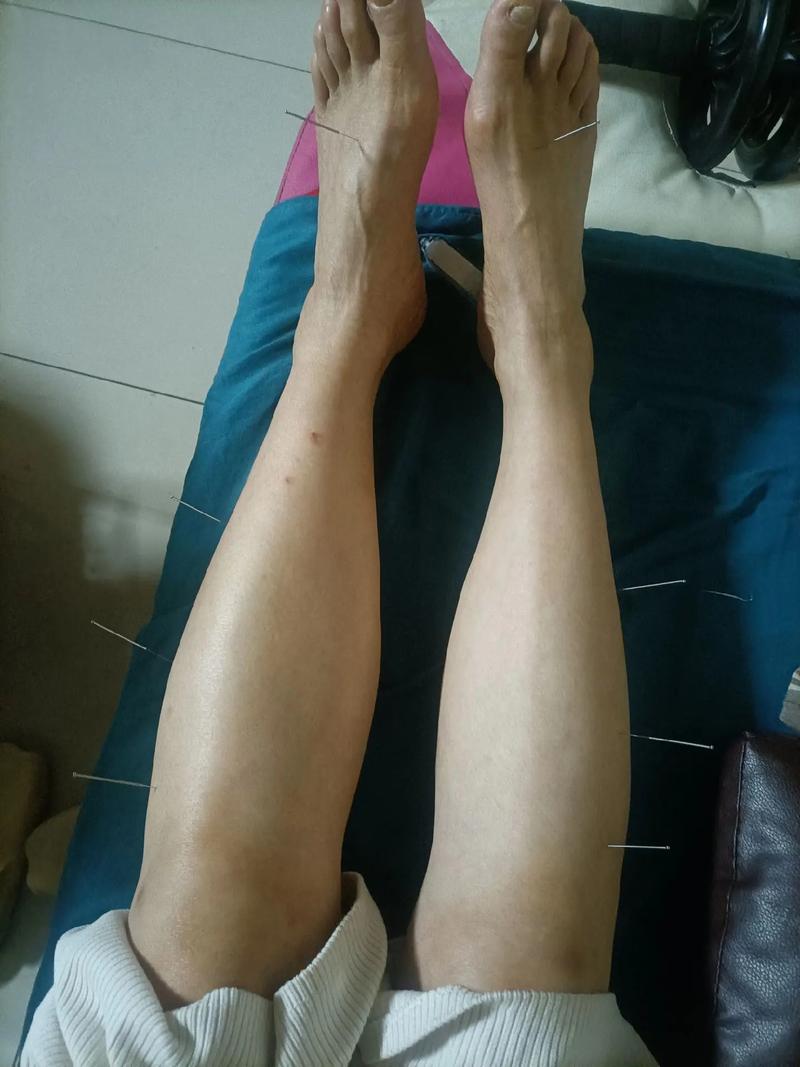 针灸减大腿要多久时间
