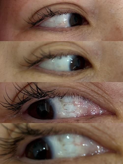 针灸后眼睛看东西模糊