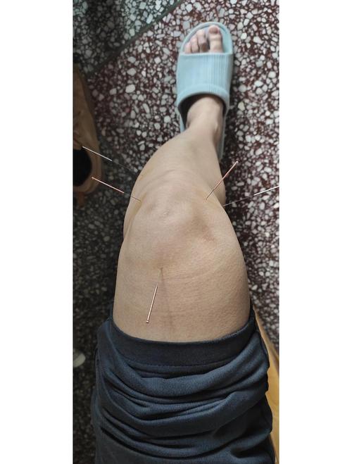 膝盖有积液可以针灸吗