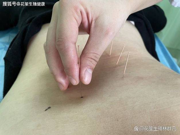 怀孕初期可以做针灸吗