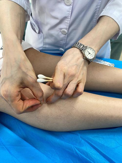 怀孕初期可以做针灸吗