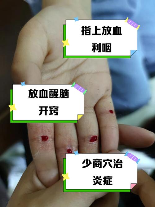 针灸扎大拇指治疗什么