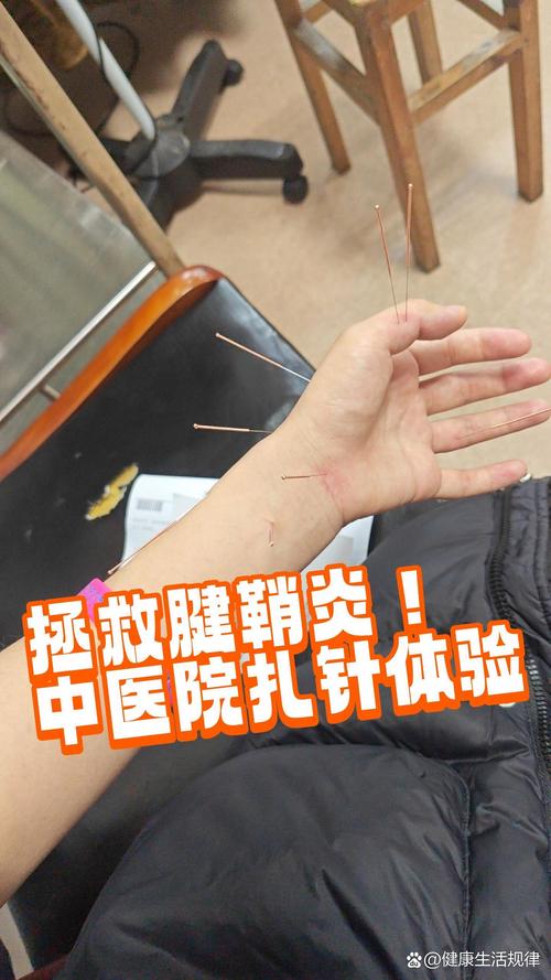 针灸扎大拇指治疗什么