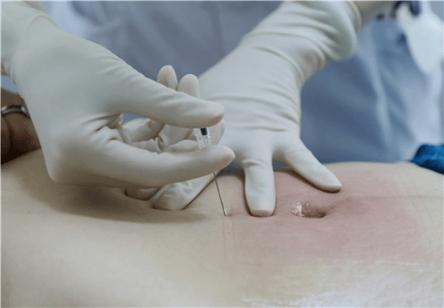 艾灸针灸治疗多囊卵巢