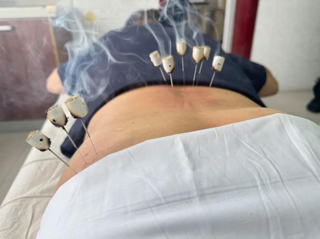 实拍女人腰椎针灸视频