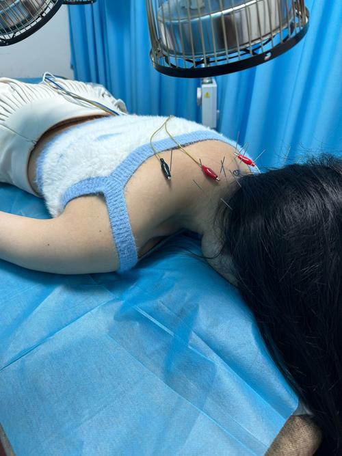 实拍女人腰椎针灸视频