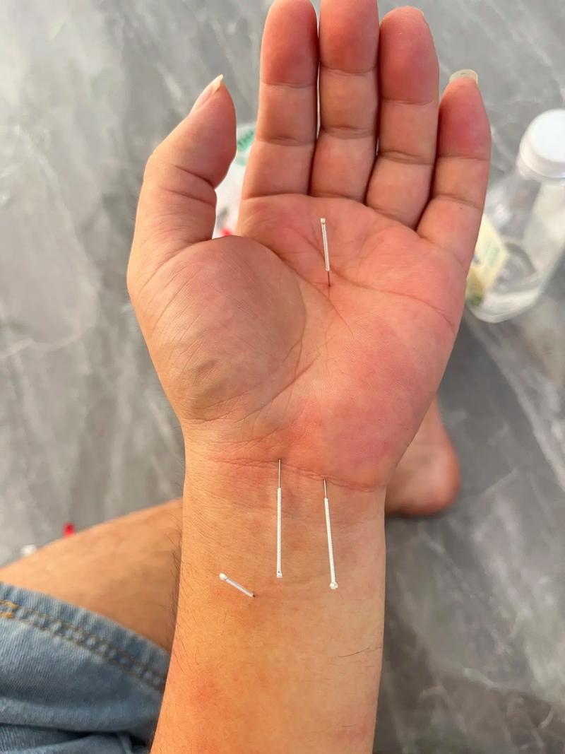 心脏不好针灸怎么治疗