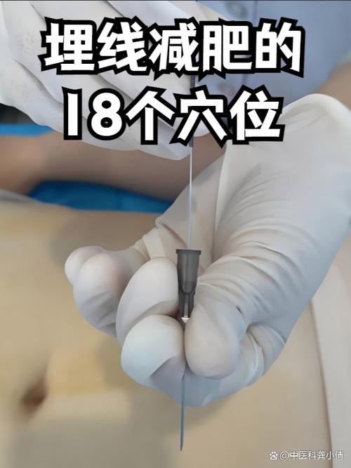 腹部针灸减肥视频教程