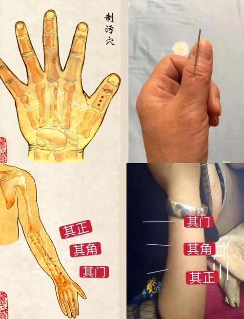 针灸治子宫肌瘤扎哪里