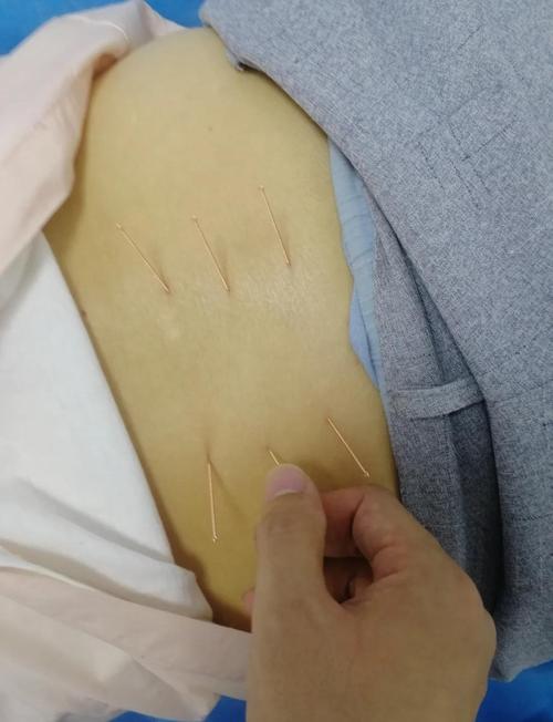 半身不遂针灸治疗视频