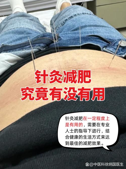 针灸减肥的原理及危害