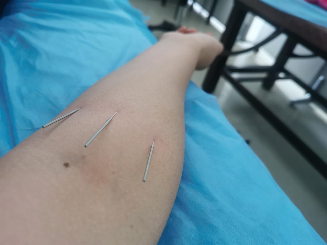 乳腺增生做针灸管用吗