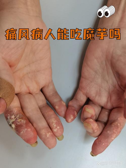 土豆 痛风病人能吃吗