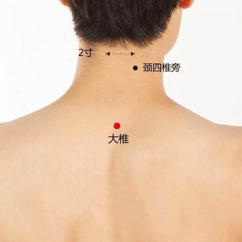 大椎富贵包的针灸方法