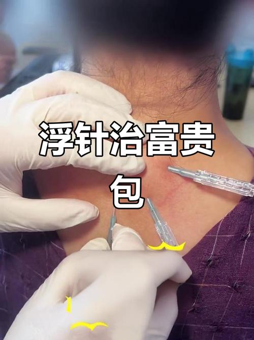 大椎富贵包的针灸方法