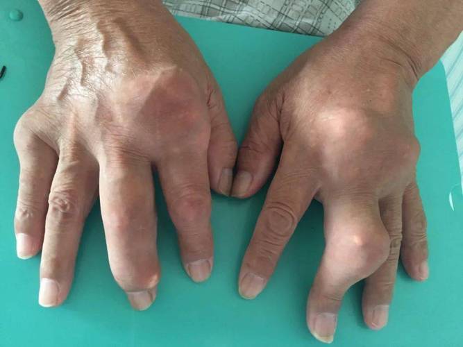 类风湿性关节炎 痛风