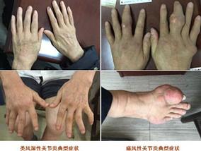 类风湿性关节炎 痛风