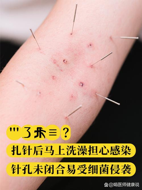 隐形针灸为什么那么烫