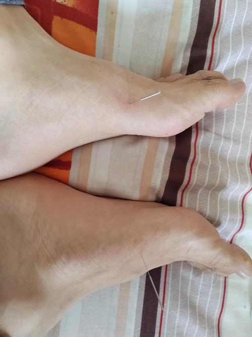 针灸后脚麻多久能恢复