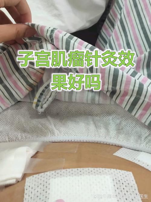 针灸能治疗子宫肌瘤吗