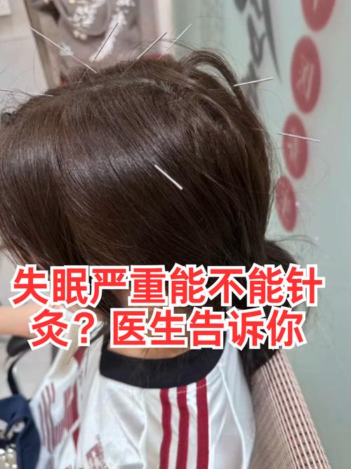 失眠扎针灸多久扎哪里