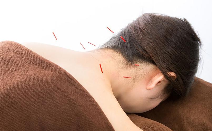 失眠扎针灸多久扎哪里