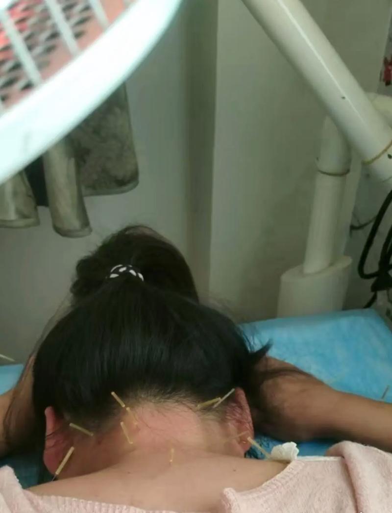 怀孕了可以针灸颈椎吗