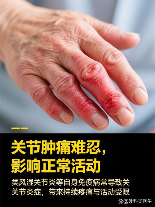 醋酸泼尼松能治痛风吗