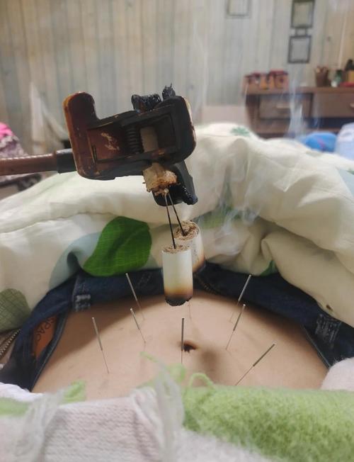 胃炎针灸艾灸有效果吗