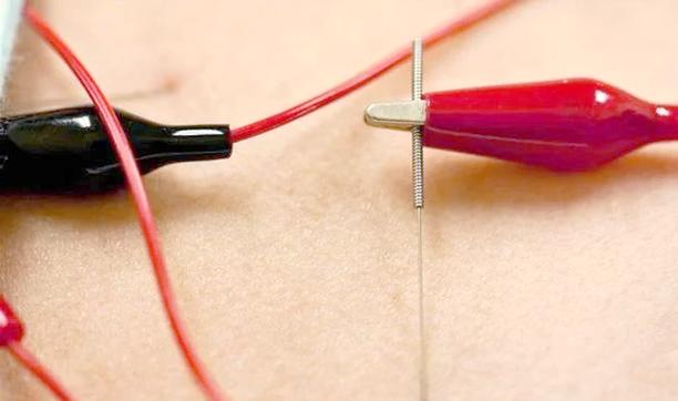 电针和针灸哪个效果好