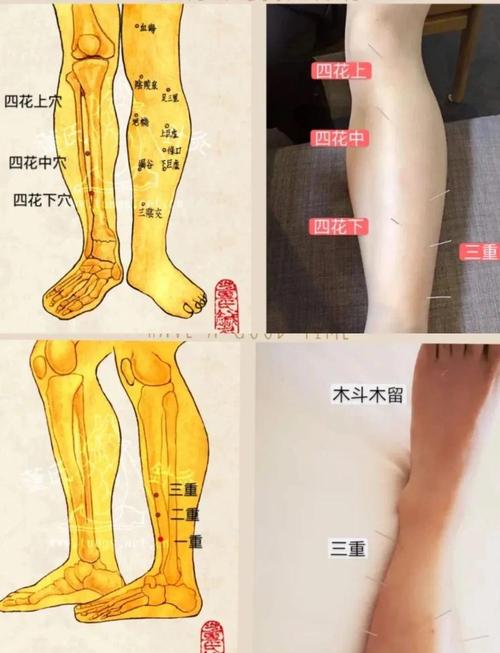 针灸可以治子宫肌瘤吗