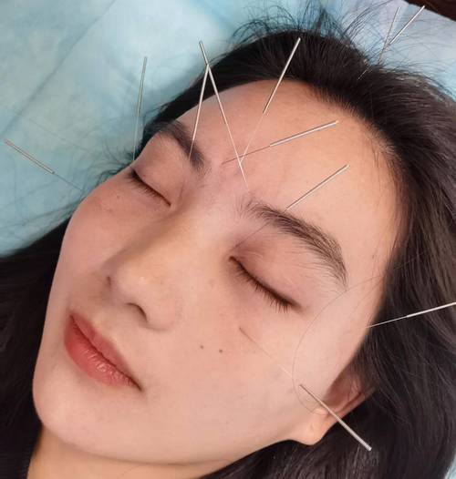 眼睑痉挛针灸能治好吗