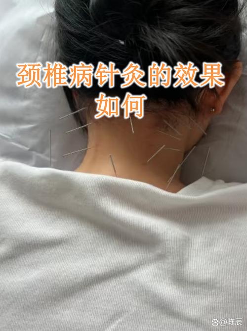 针灸后多久有感染症状