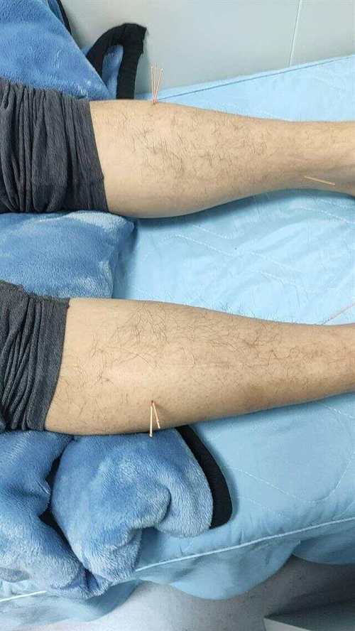 针灸治胃病多久才能好