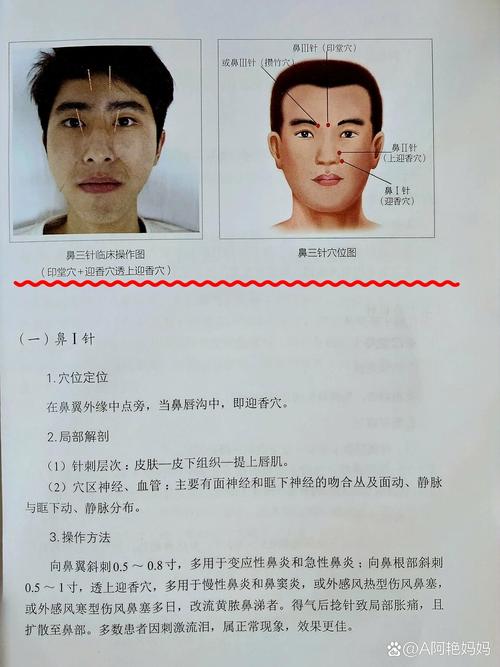 针灸鼻炎怎么治疗方法