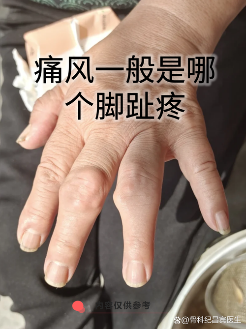 痛风一般在什么部位痛