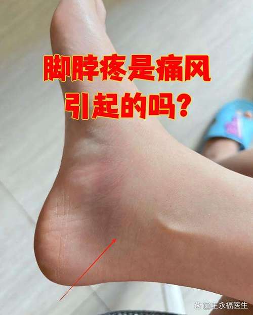 痛风一般在什么部位痛