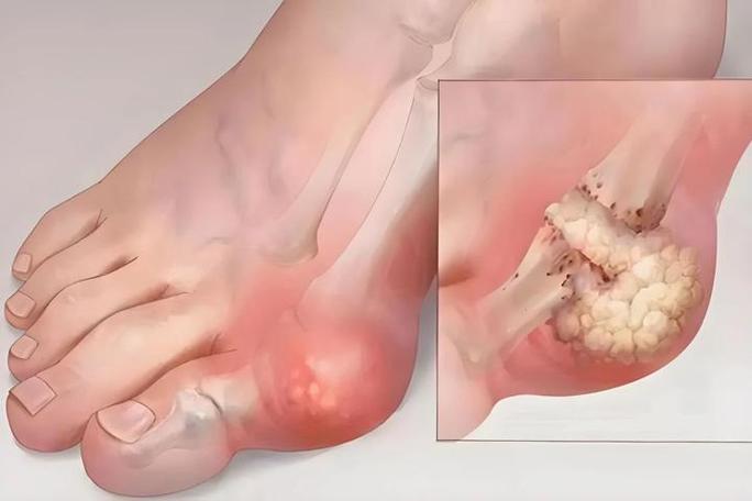 痛风怎么溶解尿酸结晶