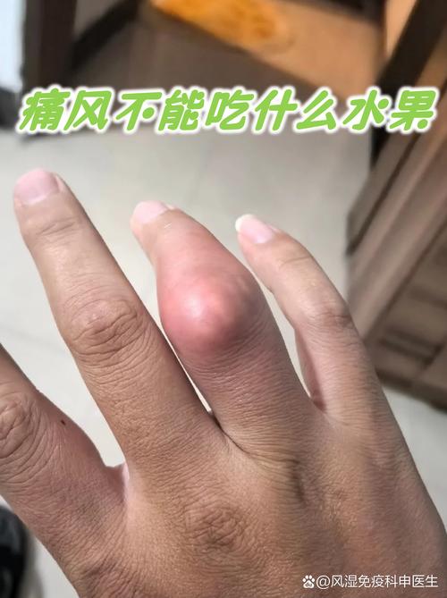 痛风的不能吃什么水果