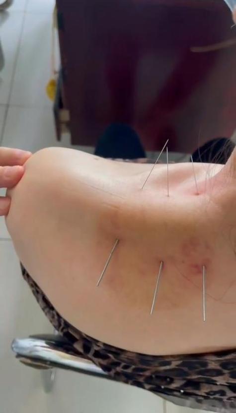 针灸治肩周炎效果咋样