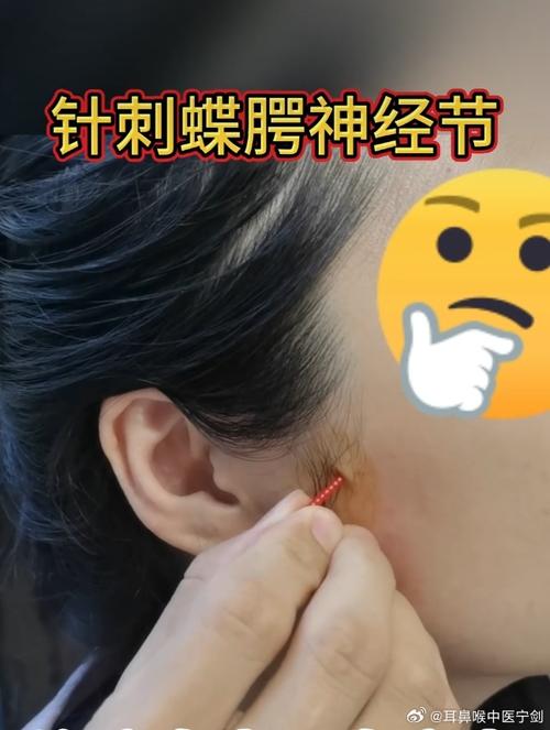 下颌关节紊乱针灸好了