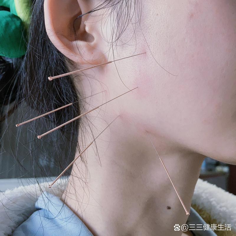 下颌关节紊乱针灸好了