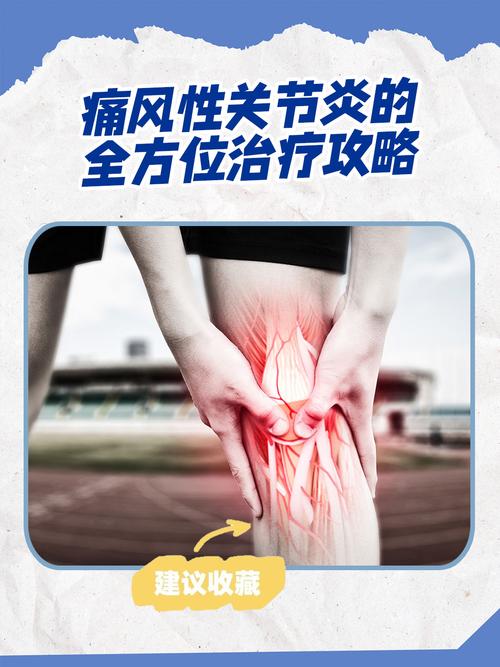 怎么治疗痛风性关节炎