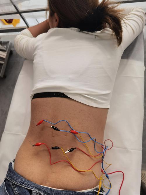 针灸背部真实图片大全