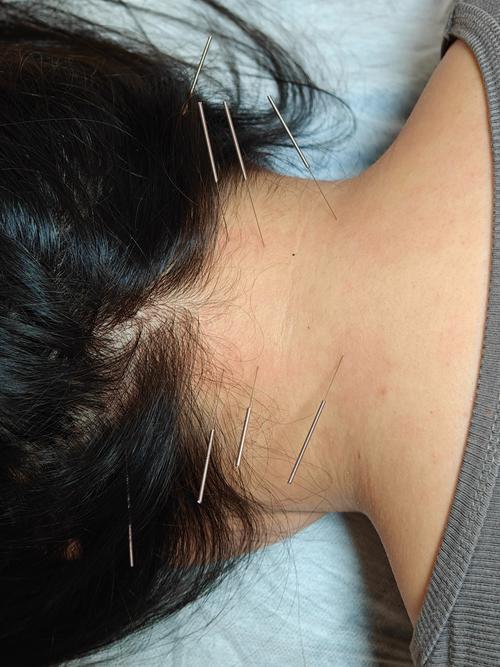 针灸背部真实图片大全