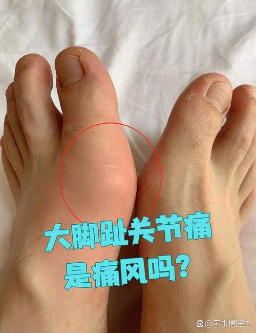 脚趾头痛一定是痛风吗