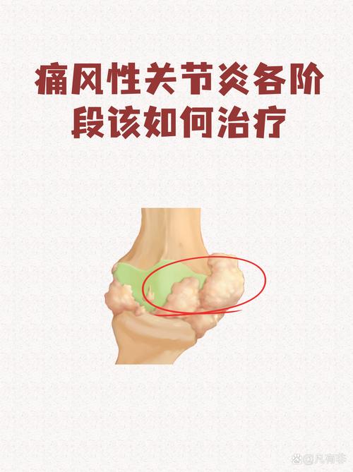 痛风性关节炎能跑步吗