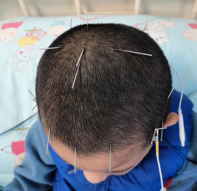 针灸治疗语言发育迟缓
