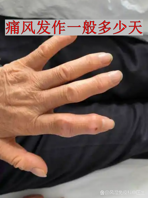 痛风发了一般几天能好