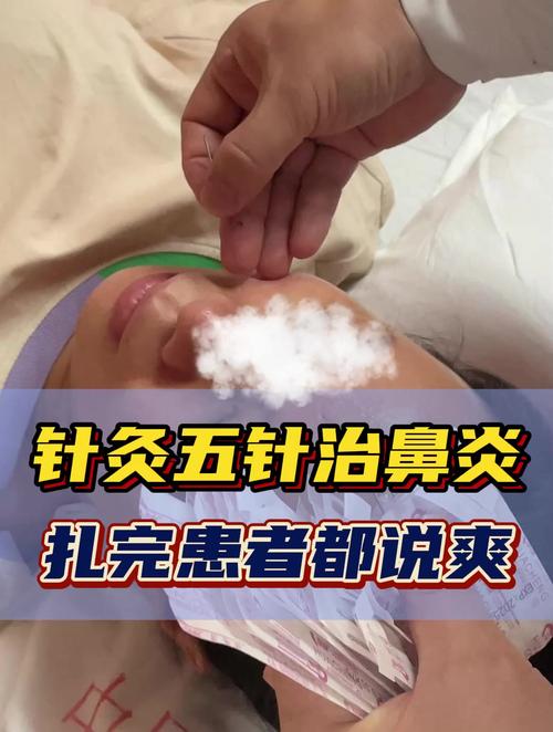 针灸治疗鼻炎效果好吗